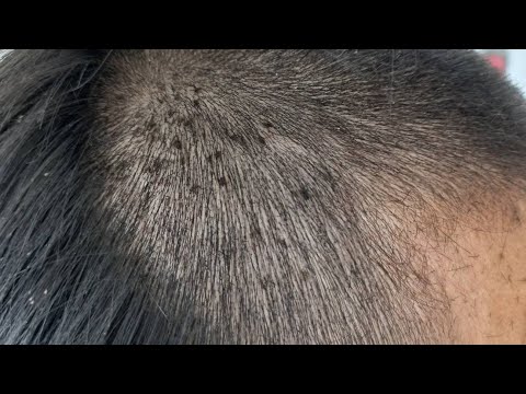 ฝันว่าจับเหาออกจากหัว 1 ตัว-lekruaythai