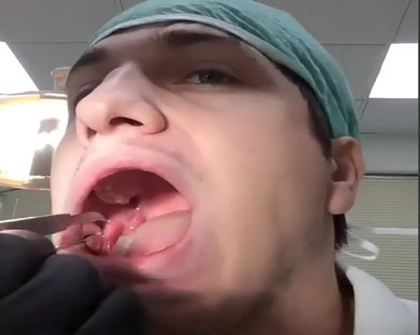 ฝันว่าถอนฟันตัวเอง 1 ซี่-''Dreamed about pulling out one of your own teeth.''