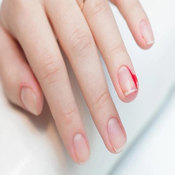 ฝันว่าเล็บฉีกเลือดออก - " dreaming-that-your-nails-are-tearing-and-bleeding "
