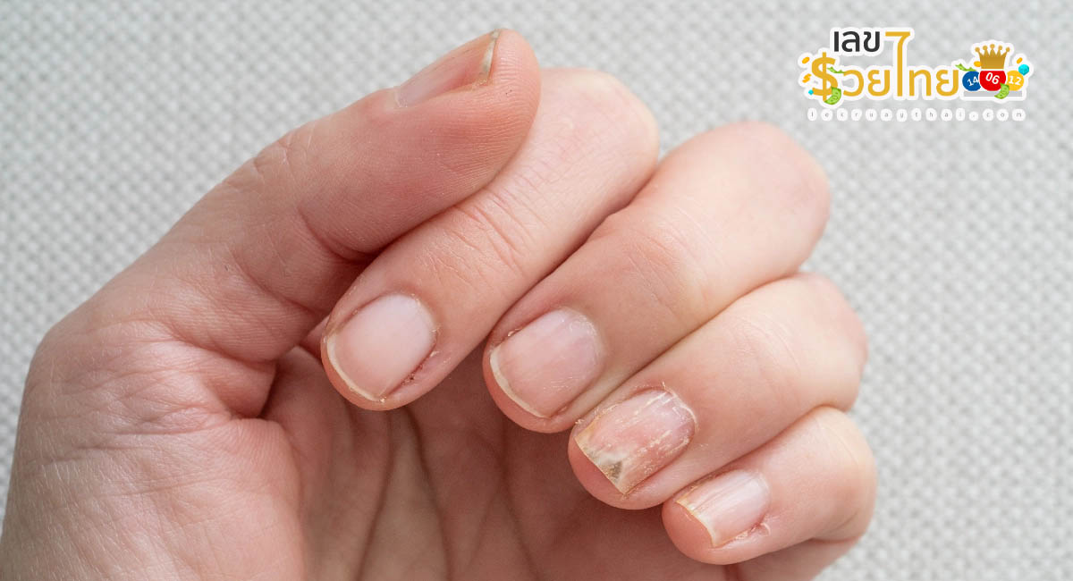 ฝันว่าเล็บมือเน่ามีหนอง - "Dreaming that your fingernails are rotten and have pus"