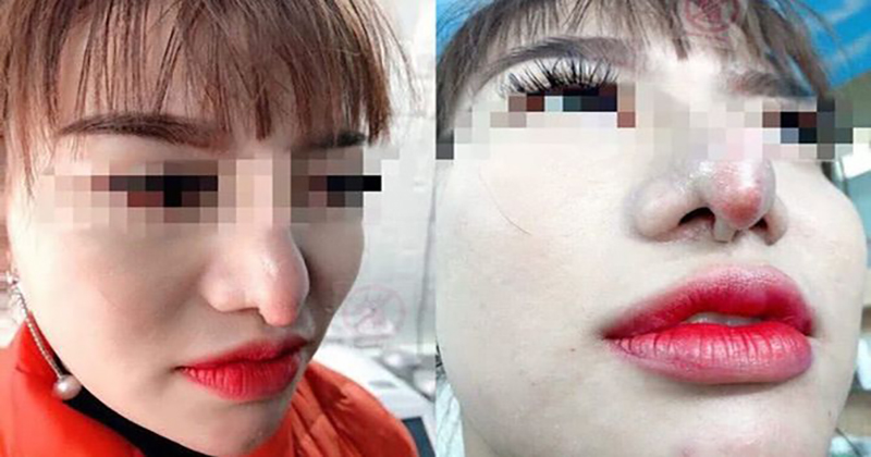 ฝันว่าเสริมจมูกแล้วทะลุ - "Dreamed of having a nose job and it was pierced"