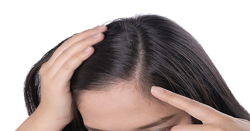 ฝันว่าผมขึ้นใหม่-"Dreamed that my hair grew back"