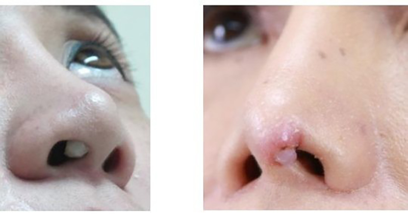 ฝันว่าทำจมูกแล้วพัง - "I dreamed that I had my nose - done and it broke"
